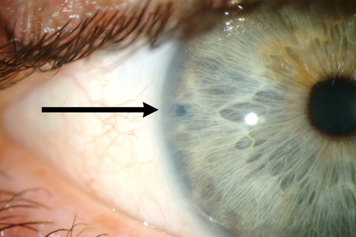 Laser Perpheral Iridotomy